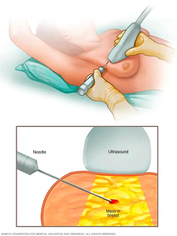 Large Core Needle Biopsy of the Breast