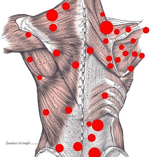 chronic myofascial pain syndrome