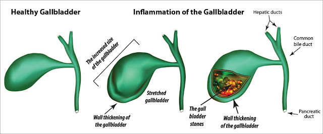 A look at a healthy gallbladder and a gallbladder that is not functioning properly.