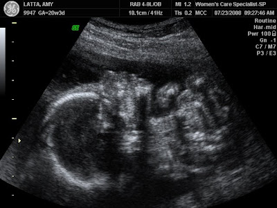 3d ultrasound pictures at 20 weeks. 3d ultrasound 20 weeks boy.