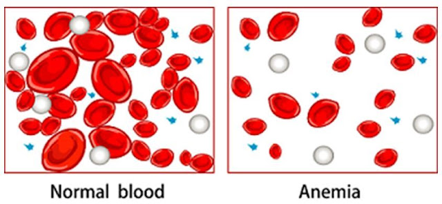 Laporan Pendahuluan Askep Anemia pdf doc