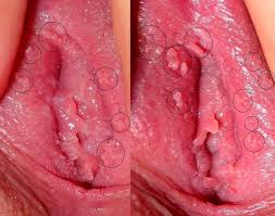 obat kutil di bibir vagina