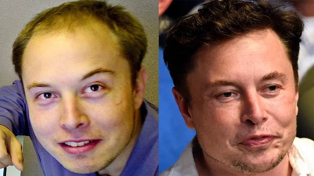 Elon Musk Defeats Baldness: What's His Secret?