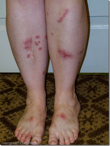 Bitten legs, day three