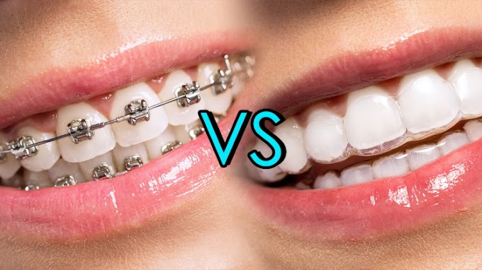 Metal Braces Vs. Invisalign: Benefits of Invisalign over Metal Braces