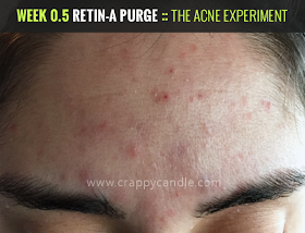 Week 0.5 Retin-A Purge :: The Acne Experiment
