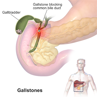  Adenomyomatosis gallbladder icd 10, Symptoms, Causes, Treatment