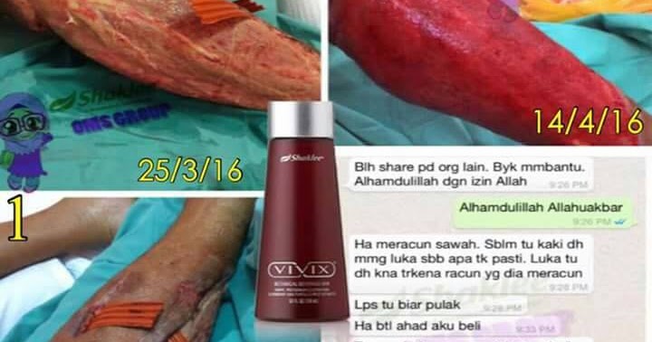 Isi Kaki Tumbuh Cantik Semula Selepas Terkena Infection 