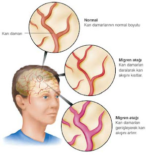 obat penyakit migren alami