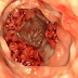 Colon cancer symptoms - Colon cancer prognosis and treatment for colon cancer.