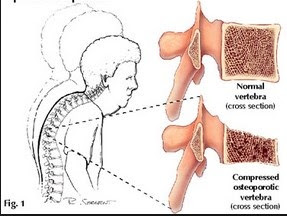 "osteoporosis"