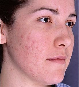 acne scars