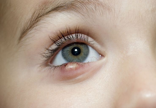 Cara mengatasi bintitan di kelopak mata