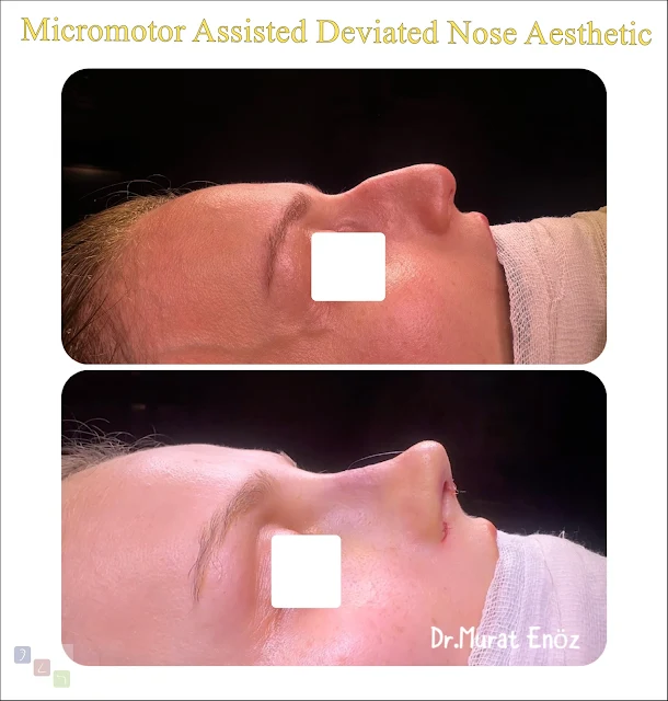 micromotor assisted deviated nose aesthetics, micromotor rhinoplasty, deviated nose correction, nasal deviation surgery, micromotor osteotomy, crooked nose surgery, advanced rhinoplasty techniques, nasal aesthetics, micromotor nose surgery, micromotor rhinoplasty recovery, precision rhinoplasty, deviated septum correction, functional rhinoplasty, breathing improvement surgery, minimally invasive rhinoplasty
