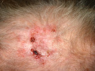 skin cancer on scalp