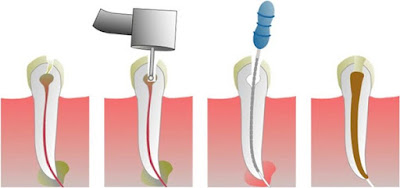  Cách điều trị răng bị sâu tới tủy như thế nào?