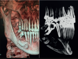 Usury technique on first lower molar