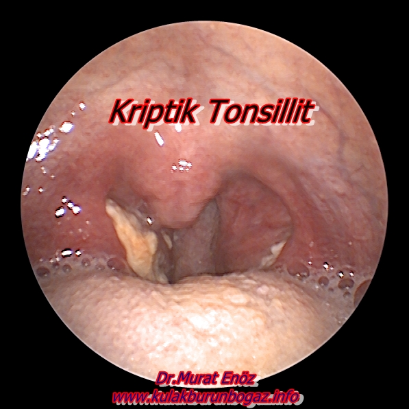 cryptic tonsillitis