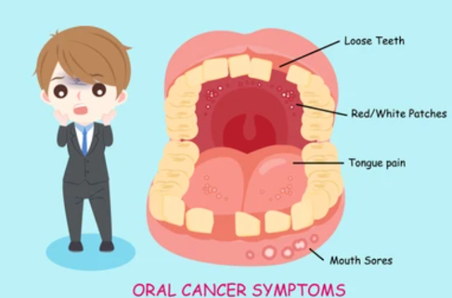 Understanding Early Stage Mouth Cancer Symptoms A Comprehensive Guide
