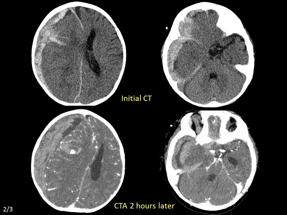 Ruptured pseudoaneurysm