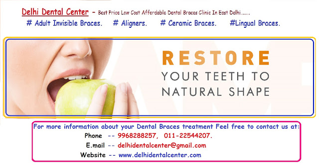 Dental Braces clinic Delhi, Dental Braces Delhi, orthodontist Delhi, Dental Braces in Delhi, Braces Dentist in Delhi, Braces Delhi, Braces Clinic in Delhi, Dental Braces Treatment in Delhi.