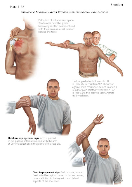 Impingement Syndrome And The Rotator Cuff