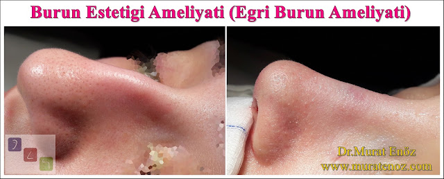 Burun estetiği ameliyatı - Bayan burun estetiği - Açık teknik burun estetiği ameliyatı - Eğri burun tedavisi - Eğri burun ameliyatı - Female Nose Aesthetic Surgery - Nose Jobs For Women - Nose Reshaping for Women - Best Rhinoplasty For Women Istanbul - Female Rhinoplasty Istanbul - Nose Job Surgery for Women - Women's Rhinoplasty - Nose Aesthetic Surgery For Women - Female Rhinoplasty Surgery in Istanbul - Female Rhinoplasty Surgery in Turkey - Eğri burun nedenleri - Eğri burun tanımı - Eğri burun estetiği - Eğri burun ameliyatı - Eğri burun tedavisindeki zorluklar - Crooked nose - Deviated nose - Twisted nose - Deflected nose - Asymmetric nose - Scoliotic nose - Eğri burun - C burun - S-shaped crooked nose deformity -  Rhinoplasty Istanbul - Rhinoplasty in Istanbul - Rhinoplasty Turkey - Rhinoplasty in Turkey – Rhinoplasty doctor in Istanbul – ENT doctor in Istanbul - Nose Job in Istanbul - Before and after rhinoplasty photos