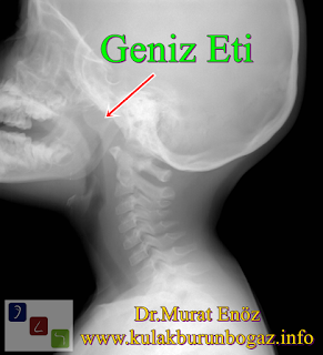 Geniz eti büyümesi - Adenoid hipertrofisi
