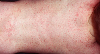 Roseola infantum rash on the chest and stomach  