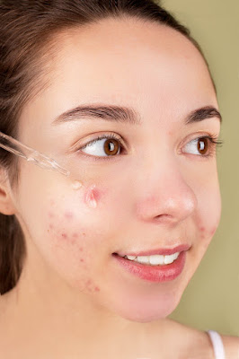 Latest news on the causes of acne breakouts and their treatment