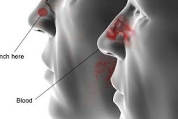 11 Cara Mengatasi Mimisan pada Ibu Hamil dan Penyebabnya