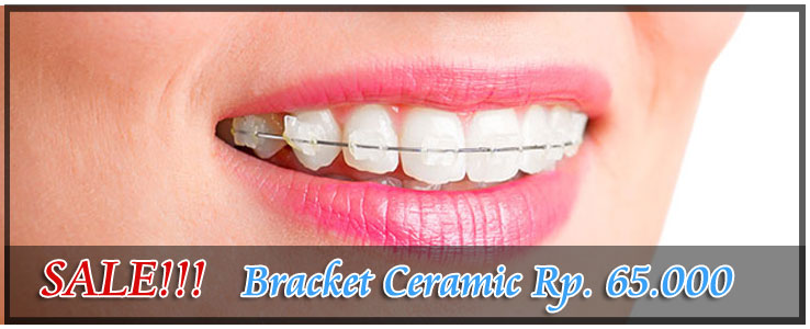  Bracket  Ceramic Kawat Gigi Simple Yang Super Murah PUSAT 