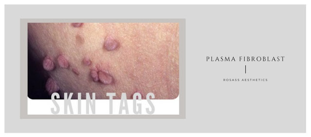 Skin tag removal