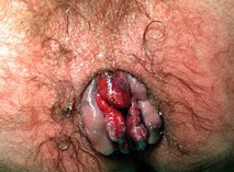how to treat internal hemorrhoids, internal hemorrhoid, internal hemorrhoids bleeding, internal hemorrhoids, internal hemorrhoid treatment, internal hemorrhoids treatment, 