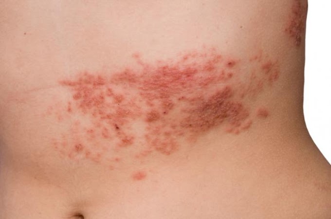 Treatment of Shingles (Herpes Zoster) using natural remedies.