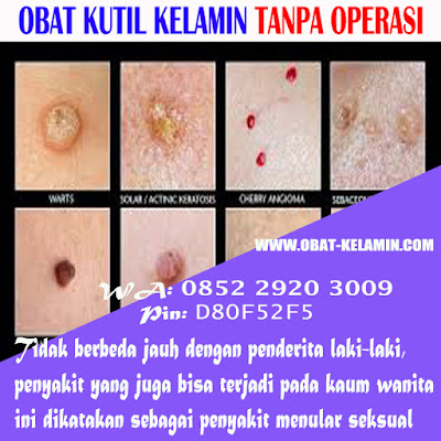 obat kutil - di kulit kemaluan kelamin, penis pria laki-laki, vagina luar dan dalam, perempuan wanita Ibu hamil menyusui mengandung, obat penghilang kutil menghilangkan kutil tanpa operasi yang terbukti dan aman terpercaya, obat penghilang kutil di kelamin, anus dubur, paha dsb