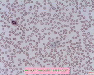 Thalassemia - Types And Treatment