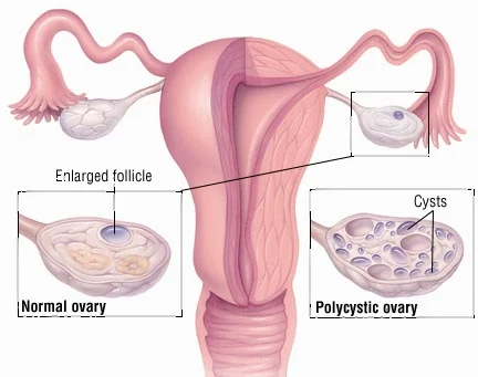 polycystic ovarian syndrome