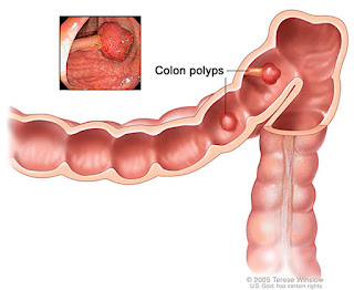 Colon Cancer: Symptoms, diagnosing and Treatment