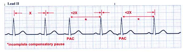 Ekg