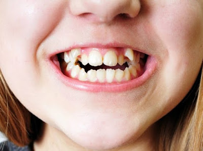 Có nên bọc răng sứ cho răng khểnh?