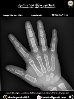 child rt hand ap view