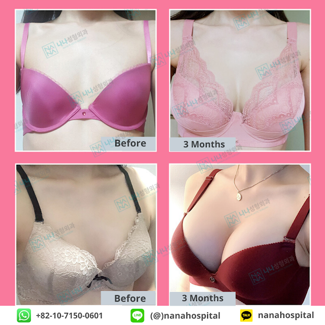 operasi payudara, implan payudara, operasi implan payudara,implan bellagel, implan motiva, promo operasi plastik, diskon, operasi plastik korea, oplas korea