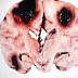 Treatment of Brain Tumor