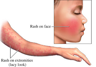 rashes on cheeks looks alike "slapped cheek" and lacy look on rashes due to fifth disease pictures