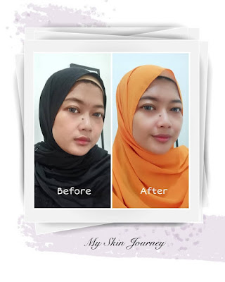 before after menggunakan scarlett acne cream