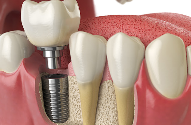 dental implants Melbourne