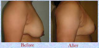 Breast lift surgery in Delhi