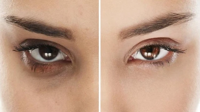 7 Tips Menghilangkan Kantung Mata dengan Bahan Alami. Nggak Perlu Ditutupi Pakai Makeup Lagi
