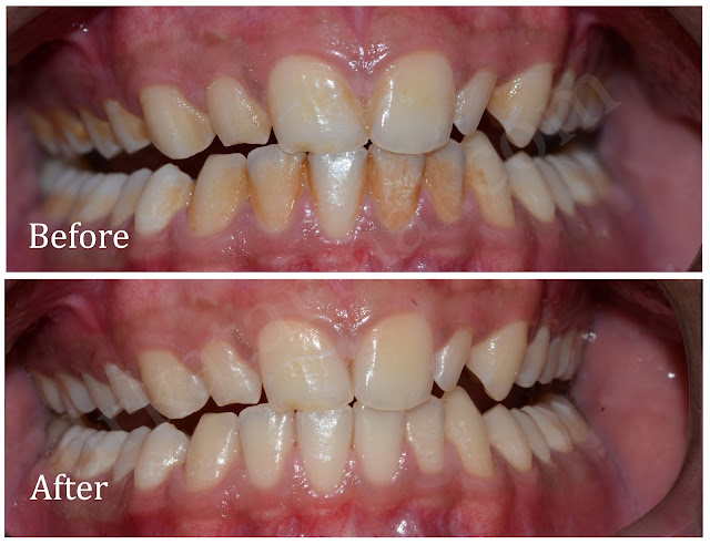 Teeth Cleaning - Removal of Tobacco Stain